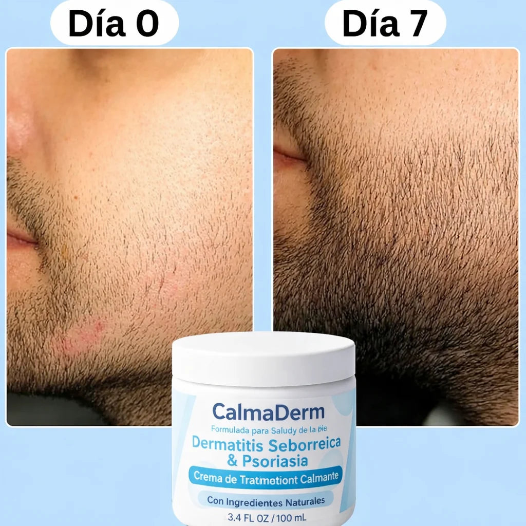 Crema Calmante: Alivio Rapido para la Picazón, Enrojecimiento y Descamación