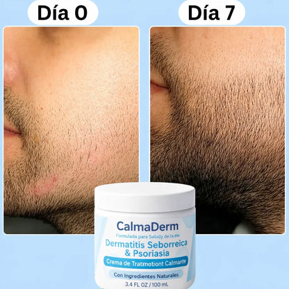Crema Calmante: Alivio Rapido para la Picazón, Enrojecimiento y Descamación