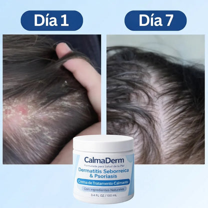 Crema Calmante: Alivio Rapido para la Picazón, Enrojecimiento y Descamación